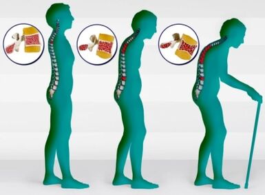 osteoporose